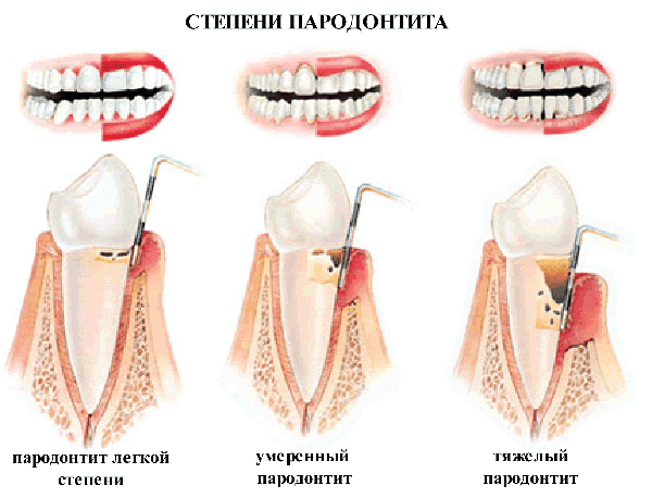Степени пародонтита